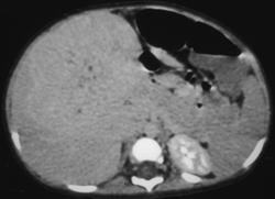 Hemangiosarcoma - CTisus CT Scan