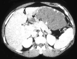 Giant Hemangioma - CTisus CT Scan