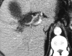 Portal Vein Thrombosis - CTisus CT Scan