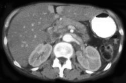 Pseudo-enhancing Lesions Near the Falciform Ligament - CTisus CT Scan