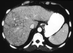 Parenchymal Liver Disease - CTisus CT Scan