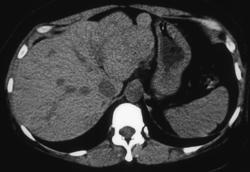 Focal Nodular Hyperplasia (FNH) - CTisus CT Scan