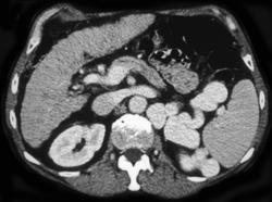 Cirrhosis With Large Splenorenal Varices - CTisus CT Scan