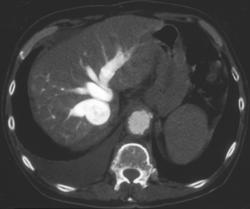 Dilated IVC and Hepatic Veins Due to Right Heart Failure - CTisus CT Scan