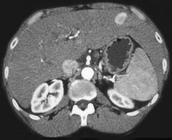 Hepatoma - CTisus CT Scan