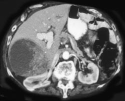 Hepatoma - CTisus CT Scan