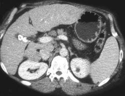 Hepatoma - CTisus CT Scan