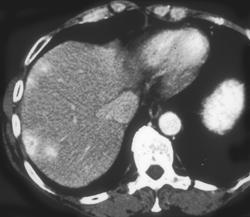 Vascular Liver Metastases From Renal Cell Cancer - CTisus CT Scan