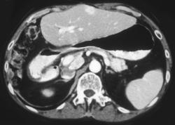 Recurrent Hepatoma and Metastases to the Tail of the Pancreas - CTisus CT Scan