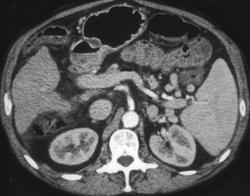 Cirrhosis With Air in the Portal Vein Due to Infectious Colitis - CTisus CT Scan