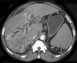 Cholangiocarcinoma - CTisus CT Scan