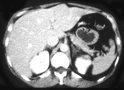 Focal Nodular Hyperplasia (FNH) - CTisus CT Scan