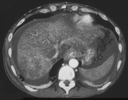 Cirrhosis With Rectal Varices - CTisus CT Scan