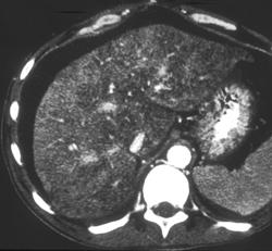 Cirrhosis and Fatty Liver - CTisus CT Scan