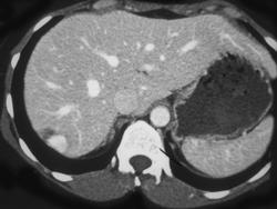 Hemangioma - CTisus CT Scan