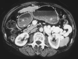 Cirrhosis With Large Varices Only Enhanced on Later Phase Images. Not Superior Mesenteric Vein (SMV) Pseudo-clot - CTisus CT Scan