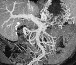 Cirrhosis With Gastric Varices - CTisus CT Scan