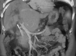 Cholangiocarcinoma Invades the Portal Vein - CTisus CT Scan