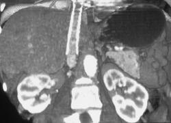 Patient Transjugular Intrahepatic Portosystemic Shunt (TIPS) Catheter - CTisus CT Scan