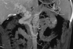 Cavernous Transformation of the Portal Vein - CTisus CT Scan