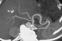 3D of the Hepatic Artery Arises Off the SMA - CTisus CT Scan