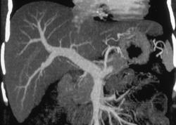 Nice 3D of the Portal Vein - CTisus CT Scan