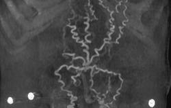 Abdominal Wall Varices - CTisus CT Scan