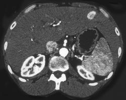 Hepatoma in the Left Lobe - CTisus CT Scan