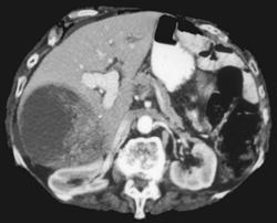 Hepatoma - CTisus CT Scan