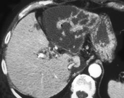 Infarcted Left Lobe of the Liver - CTisus CT Scan