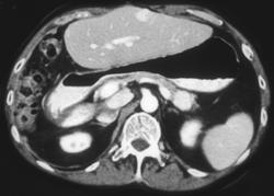 Recurrent Hepatoma With Vascular Metastases to Pancreatic Tail Also Seen - CTisus CT Scan