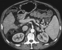 Cirrhosis - CTisus CT Scan