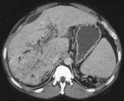 Cholangiocarcinoma - CTisus CT Scan