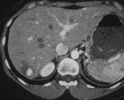 Hemangioma - CTisus CT Scan