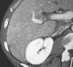 Focal Nodular Hyperplasia (FNH) - CTisus CT Scan