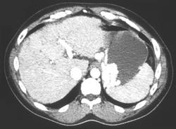 Cirrhosis With Gastric Varices Seen Only on Portal Phase - CTisus CT Scan