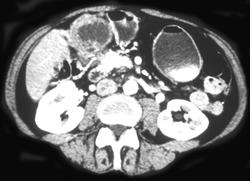 Gallbladder Cancer - CTisus CT Scan