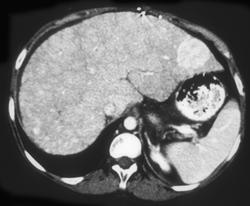 Hepatocellular Carcinoma (HCC) in Cirrhotic Liver - CTisus CT Scan