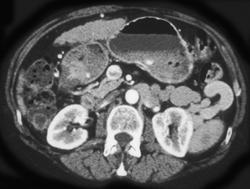 Cirrhosis With Varices and Splenorenal Shunting - CTisus CT Scan