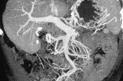 Gastric Varices Due to Cirrhosis - CTisus CT Scan