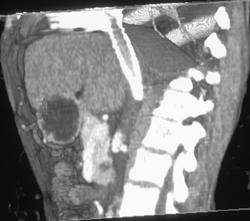 Transjugular Intrahepatic Portosystemic Shunt (TIPS) Catheter in Place - CTisus CT Scan