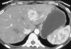 Focal Nodular Hyperplasia (FNH) - CTisus CT Scan