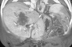 Cholangiocarcinoma - CTisus CT Scan