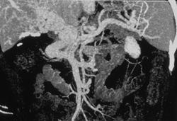 Cirrhosis With Varices - CTisus CT Scan