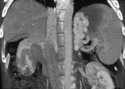 Gastric Varices - CTisus CT Scan