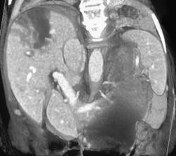 Cryosurgery Liver - CTisus CT Scan