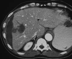 Subcapsular Hematoma S/P Trauma - CTisus CT Scan