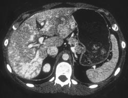 Ecstasy- Liver Vasculitis - CTisus CT Scan