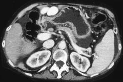 Dilated Umbilical Vein - Liver Case Studies - CTisus CT Scanning