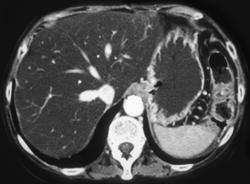 Fatty Liver - CTisus CT Scan